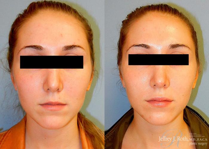 Before & After Dermal Fillers Case 154 View #2 View in Las Vegas and Henderson, NV