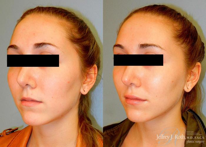 Before & After Dermal Fillers Case 154 View #3 View in Las Vegas and Henderson, NV