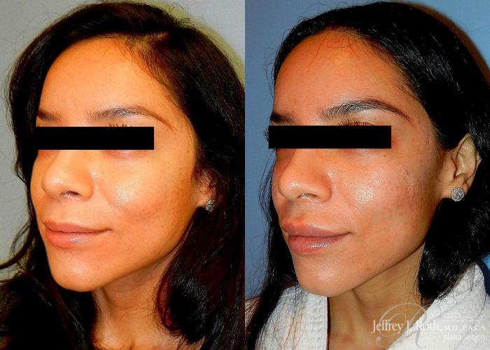 Before & After Dermal Fillers Case 155 View #2 View in Las Vegas and Henderson, NV
