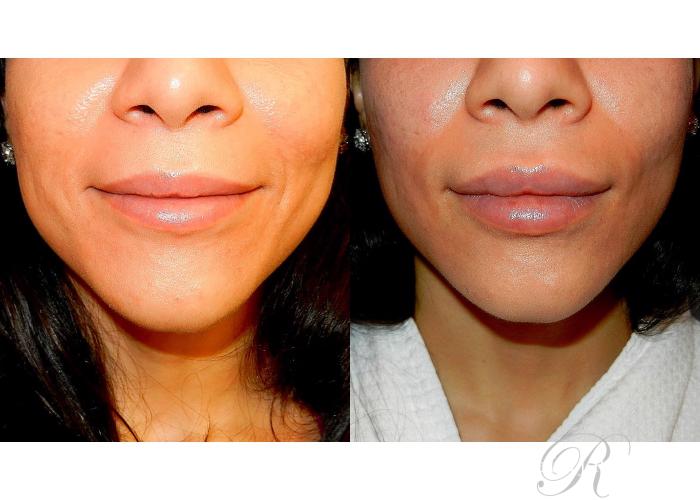 Before & After Dermal Fillers Case 155 View #3 View in Las Vegas and Henderson, NV