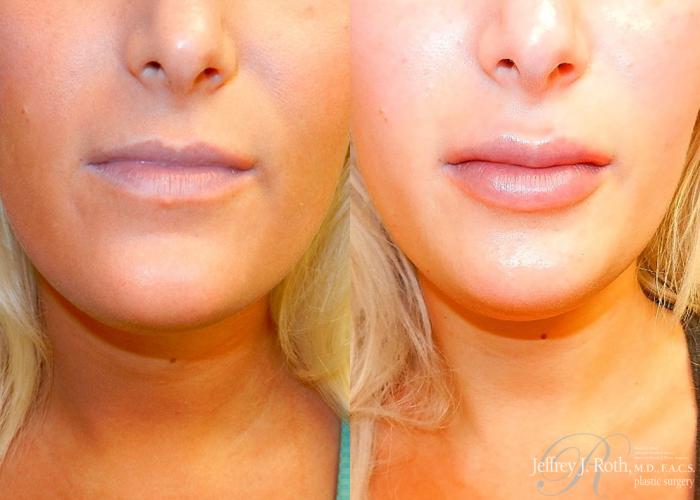 Before & After Dermal Fillers Case 156 View #1 View in Las Vegas and Henderson, NV