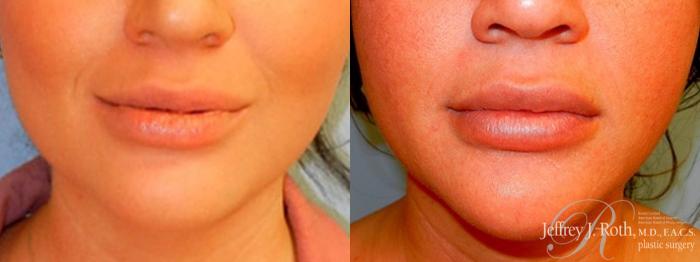 Before & After Dermal Fillers Case 157 View #1 View in Las Vegas and Henderson, NV
