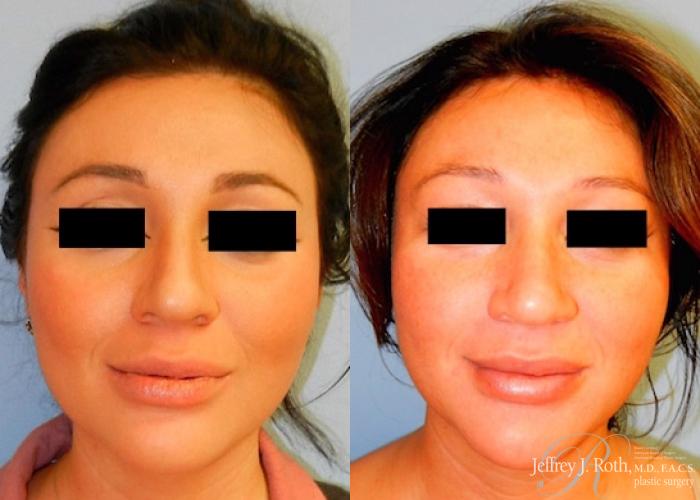 Before & After Dermal Fillers Case 157 View #2 View in Las Vegas and Henderson, NV