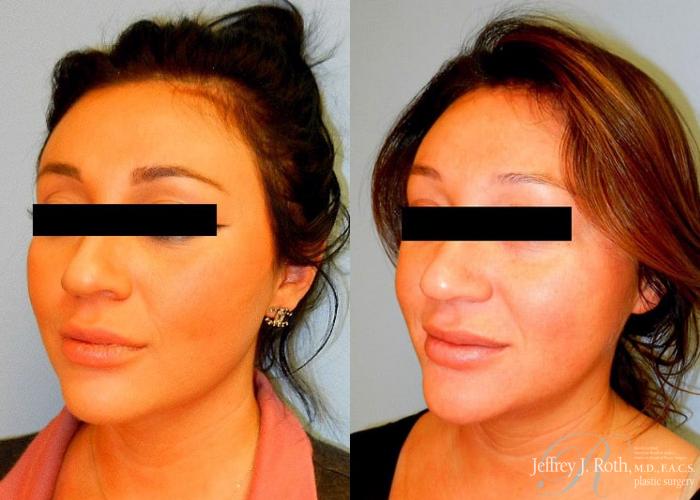 Before & After Dermal Fillers Case 157 View #3 View in Las Vegas and Henderson, NV