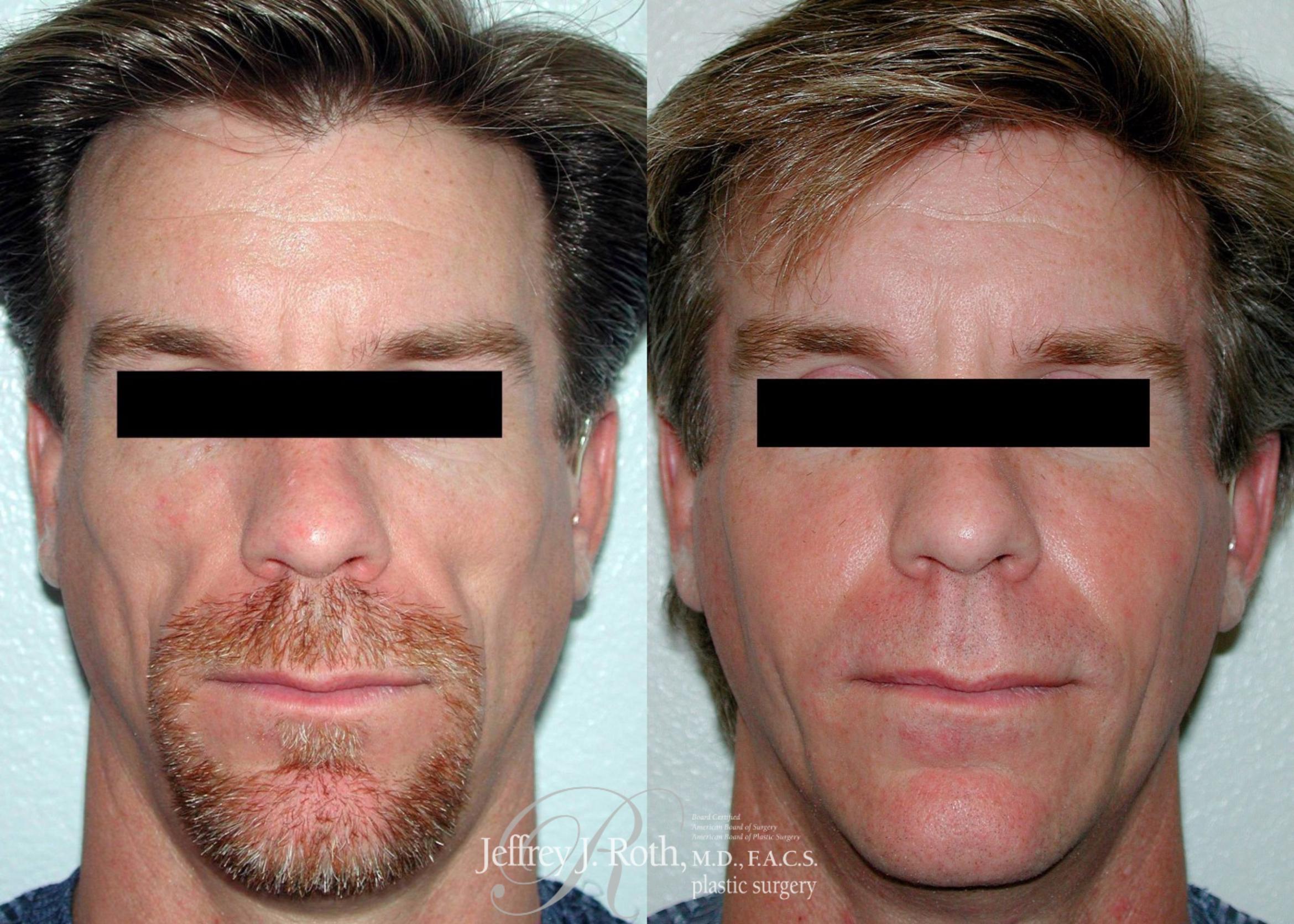 Before & After Dermal Fillers for Men Case 172 View #1 View in Las Vegas, NV