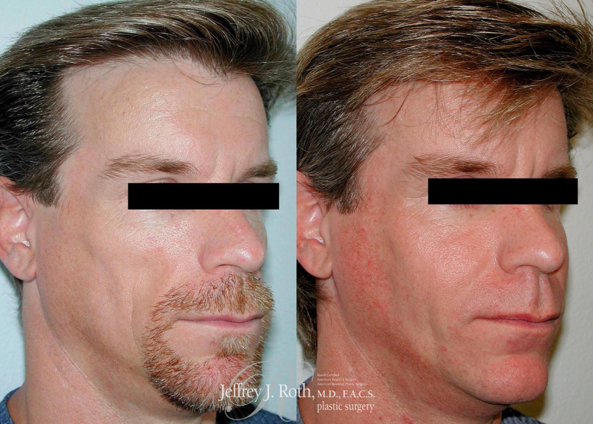 Before & After Dermal Fillers for Men Case 172 View #2 View in Las Vegas, NV