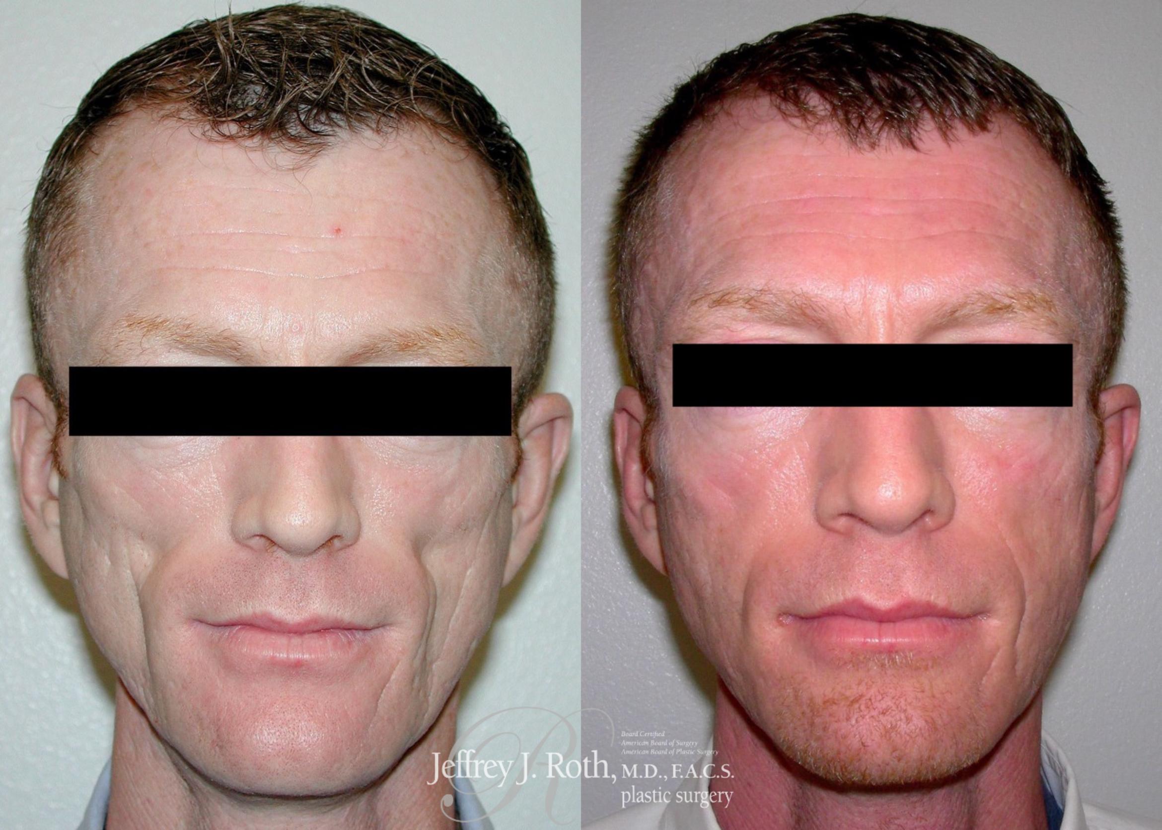 Before & After Dermal Fillers for Men Case 173 View #1 View in Las Vegas, NV