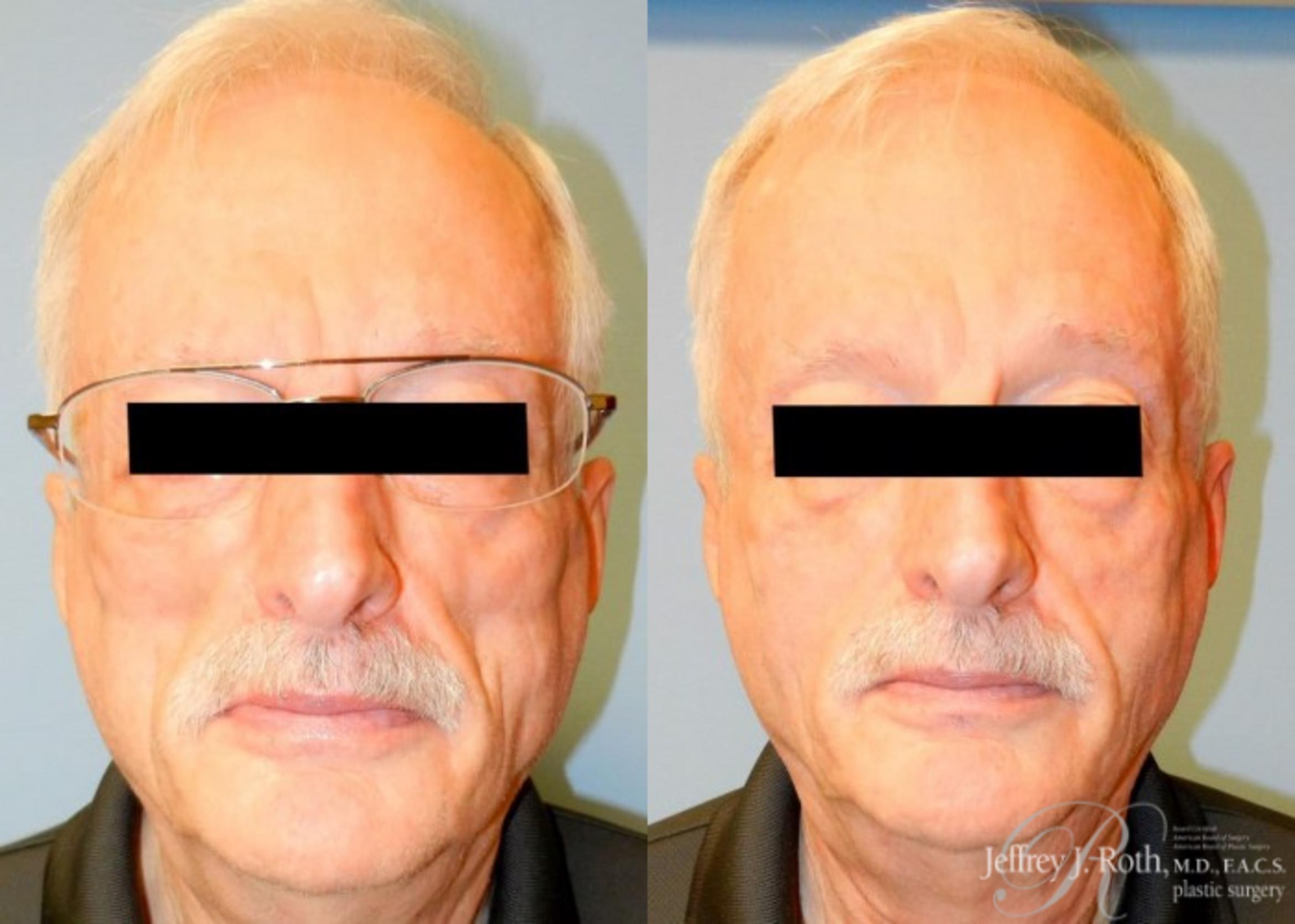 Before & After Dermal Fillers for Men Case 174 View #1 View in Las Vegas, NV