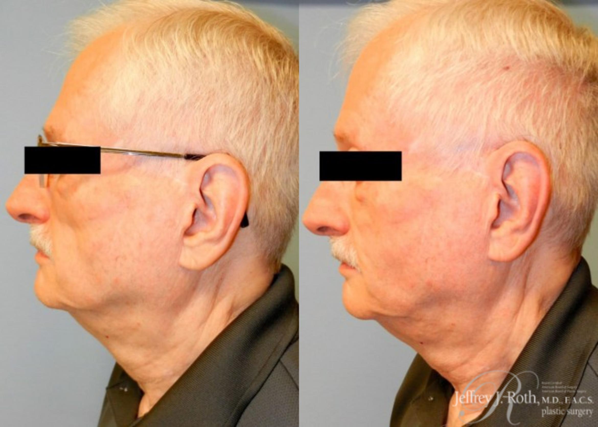 Before & After Dermal Fillers for Men Case 174 View #2 View in Las Vegas, NV