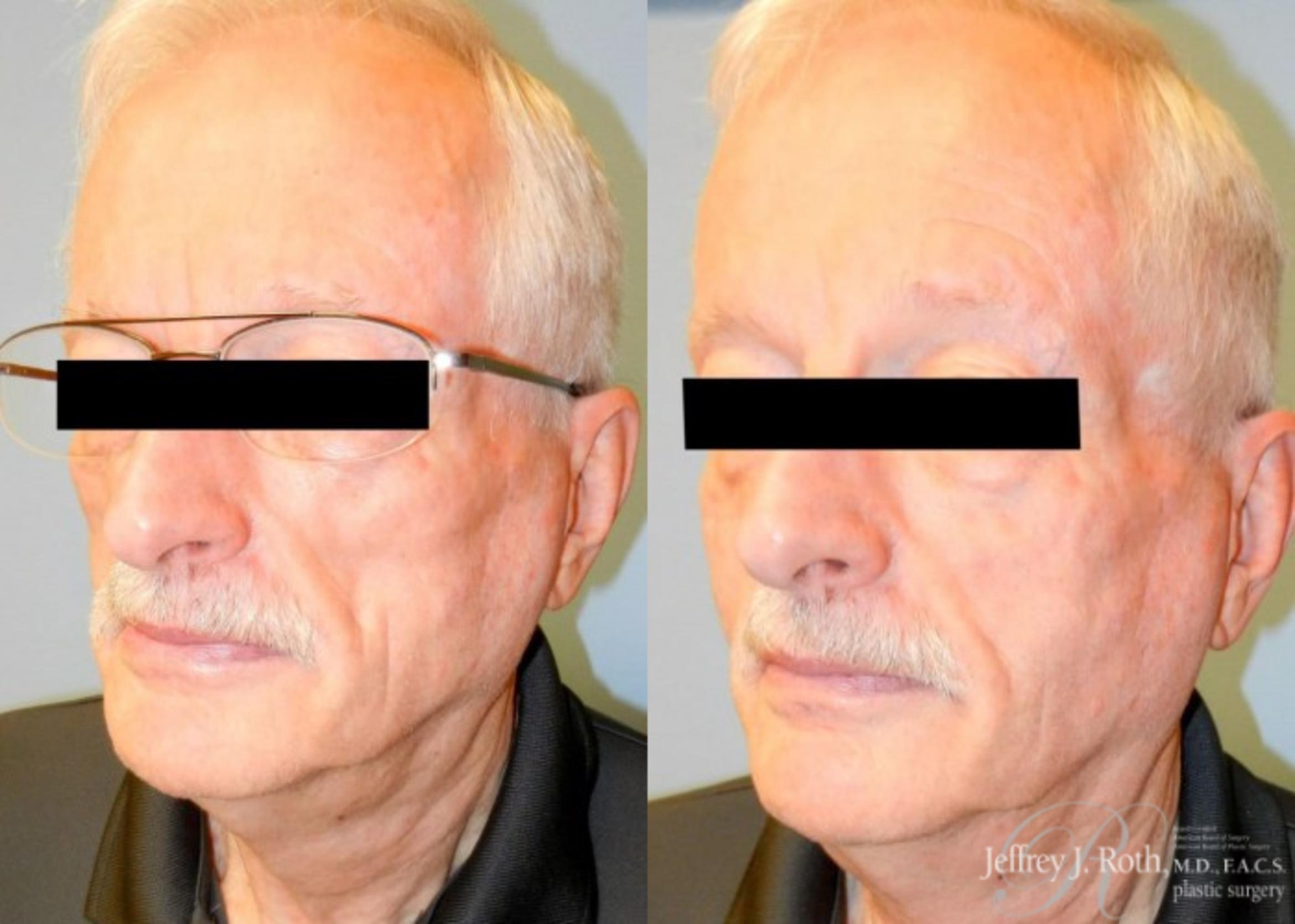 Before & After Dermal Fillers for Men Case 174 View #3 View in Las Vegas, NV