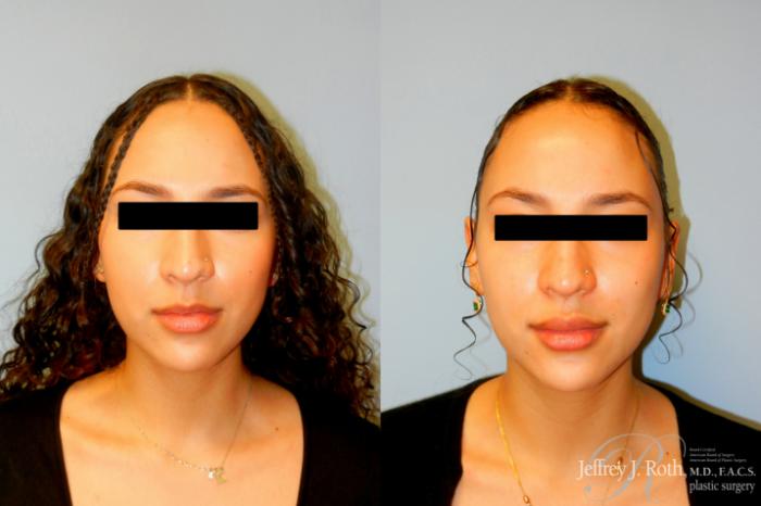 Before & After Dermal Fillers Case 241 Front View in Las Vegas and Henderson, NV
