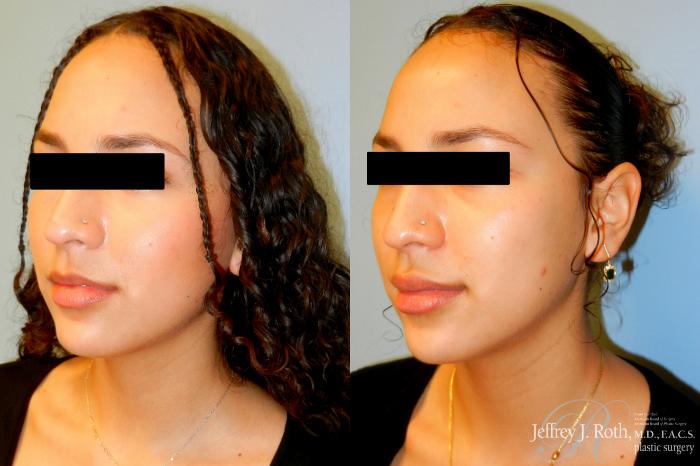 Before & After Dermal Fillers Case 241 Left Oblique View in Las Vegas and Henderson, NV