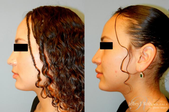 Before & After Dermal Fillers Case 241 Left Side View in Las Vegas and Henderson, NV