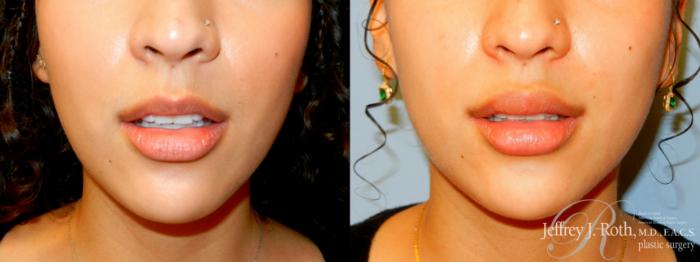 Before & After Dermal Fillers Case 242 FRONT OPEN View in Las Vegas and Henderson, NV