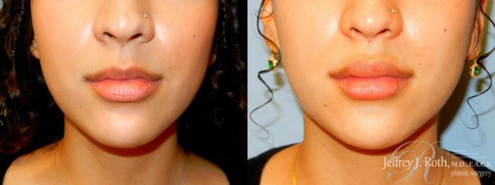 Before & After Dermal Fillers Case 242 Front View in Las Vegas and Henderson, NV