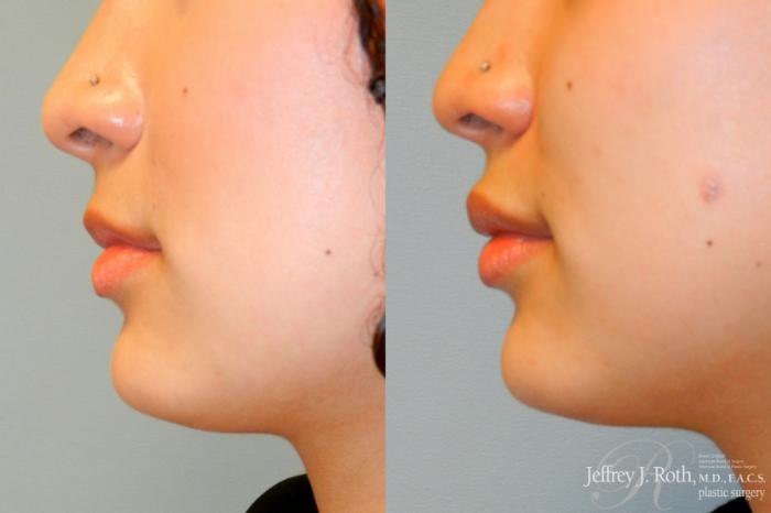 Before & After Dermal Fillers Case 242 Left Side View in Las Vegas and Henderson, NV