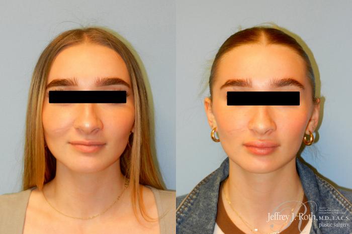 Before & After Dermal Fillers Case 243 Front View in Las Vegas and Henderson, NV