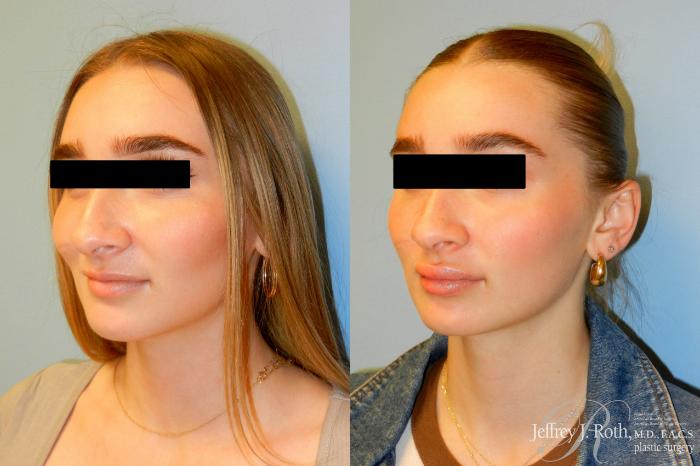 Before & After Dermal Fillers Case 243 Left Oblique View in Las Vegas and Henderson, NV