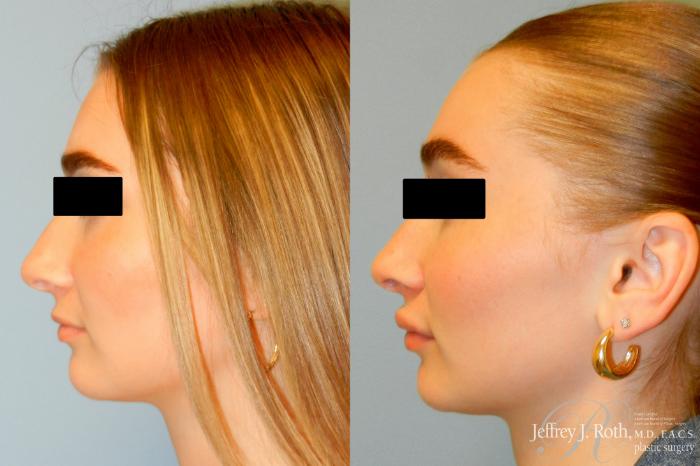 Before & After Dermal Fillers Case 243 Left Side View in Las Vegas and Henderson, NV