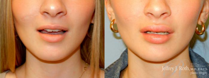 Before & After Dermal Fillers Case 244 FRONT OPEN View in Las Vegas and Henderson, NV