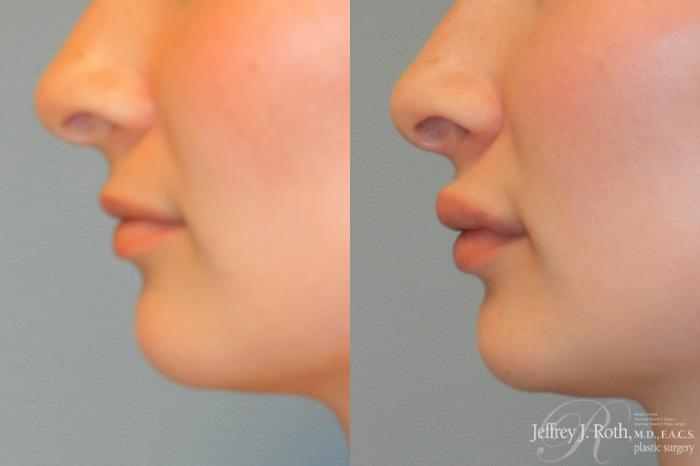 Before & After Dermal Fillers Case 244 Left Side View in Las Vegas and Henderson, NV