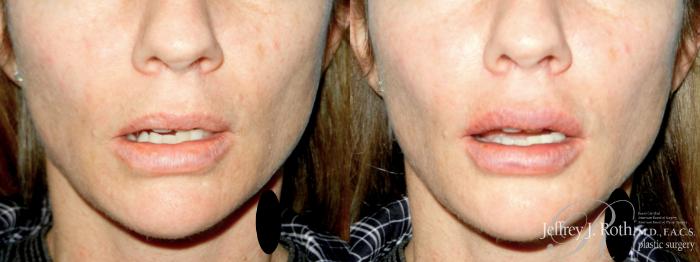 Before & After Dermal Fillers Case 346 FRONT 2 View in Las Vegas and Henderson, NV