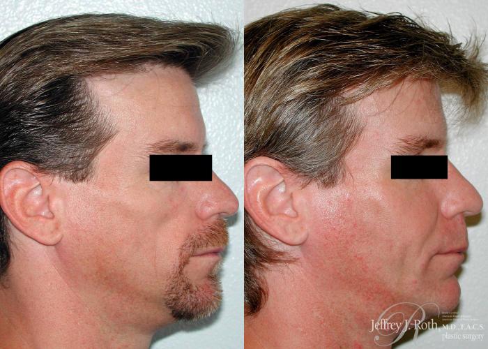 Before & After Dermal Fillers for Men Case 172 View #3 View in Las Vegas, NV