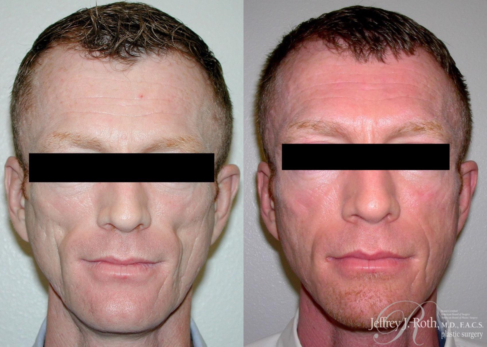 Before & After Dermal Fillers for Men Case 173 View #1 View in Las Vegas, NV