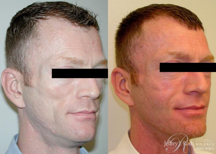 Before & After Dermal Fillers for Men Case 173 View #2 View in Las Vegas, NV