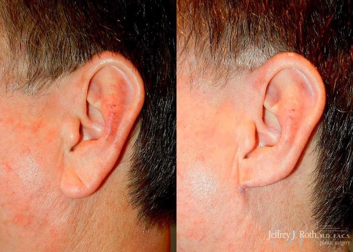 Before & After Earlobe Reduction Surgery Case 118 View #1 View in Las Vegas, NV