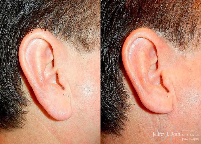 Before & After Earlobe Reduction Surgery Case 118 View #2 View in Las Vegas and Henderson, NV