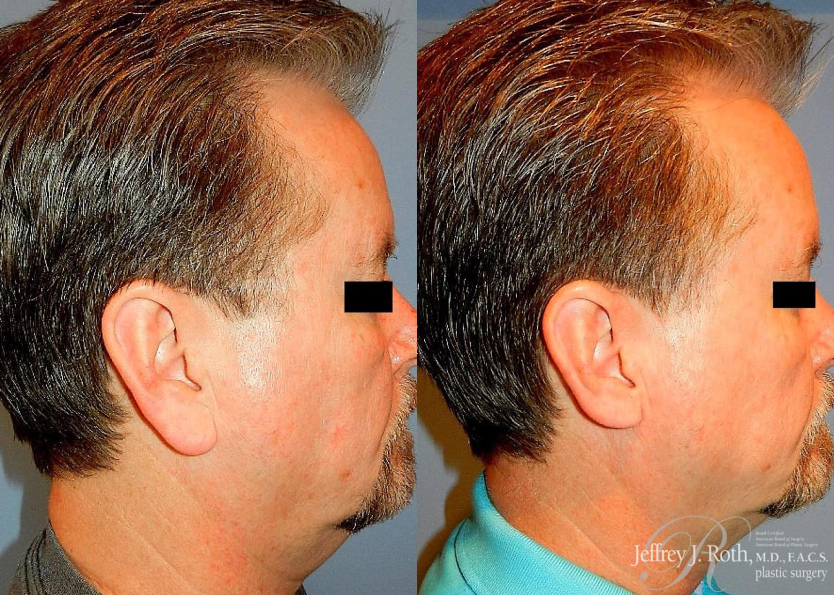 Before & After Earlobe Reduction Surgery Case 118 View #3 View in Las Vegas, NV