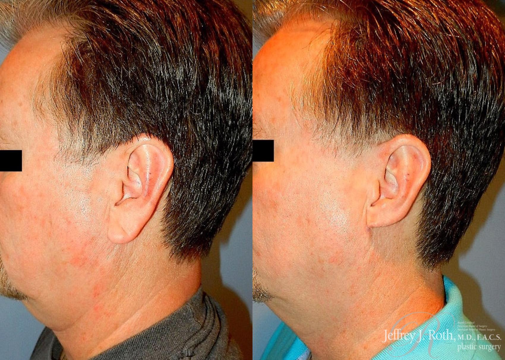 Before & After Earlobe Reduction Surgery Case 118 View #4 View in Las Vegas, NV
