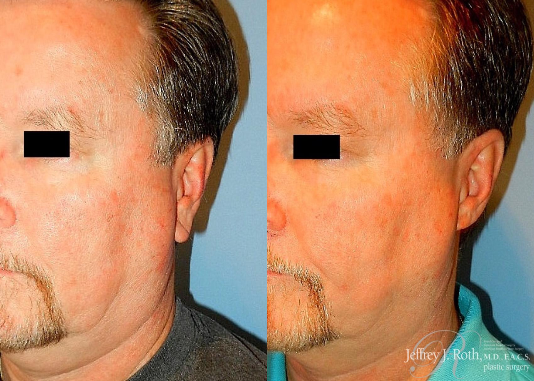 Before & After Earlobe Reduction Surgery Case 118 View #5 View in Las Vegas, NV