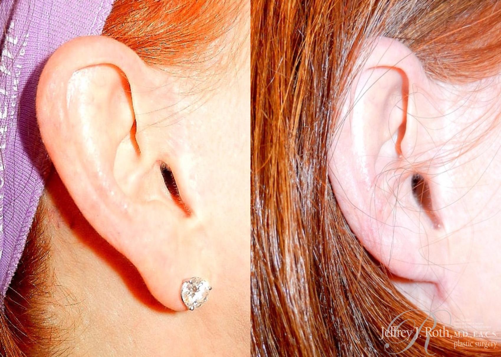 Before & After Earlobe Reduction Surgery Case 119 View #1 View in Las Vegas, NV