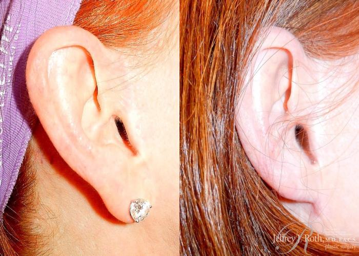 Before & After Earlobe Reduction Surgery Case 119 View #1 View in Las Vegas and Henderson, NV