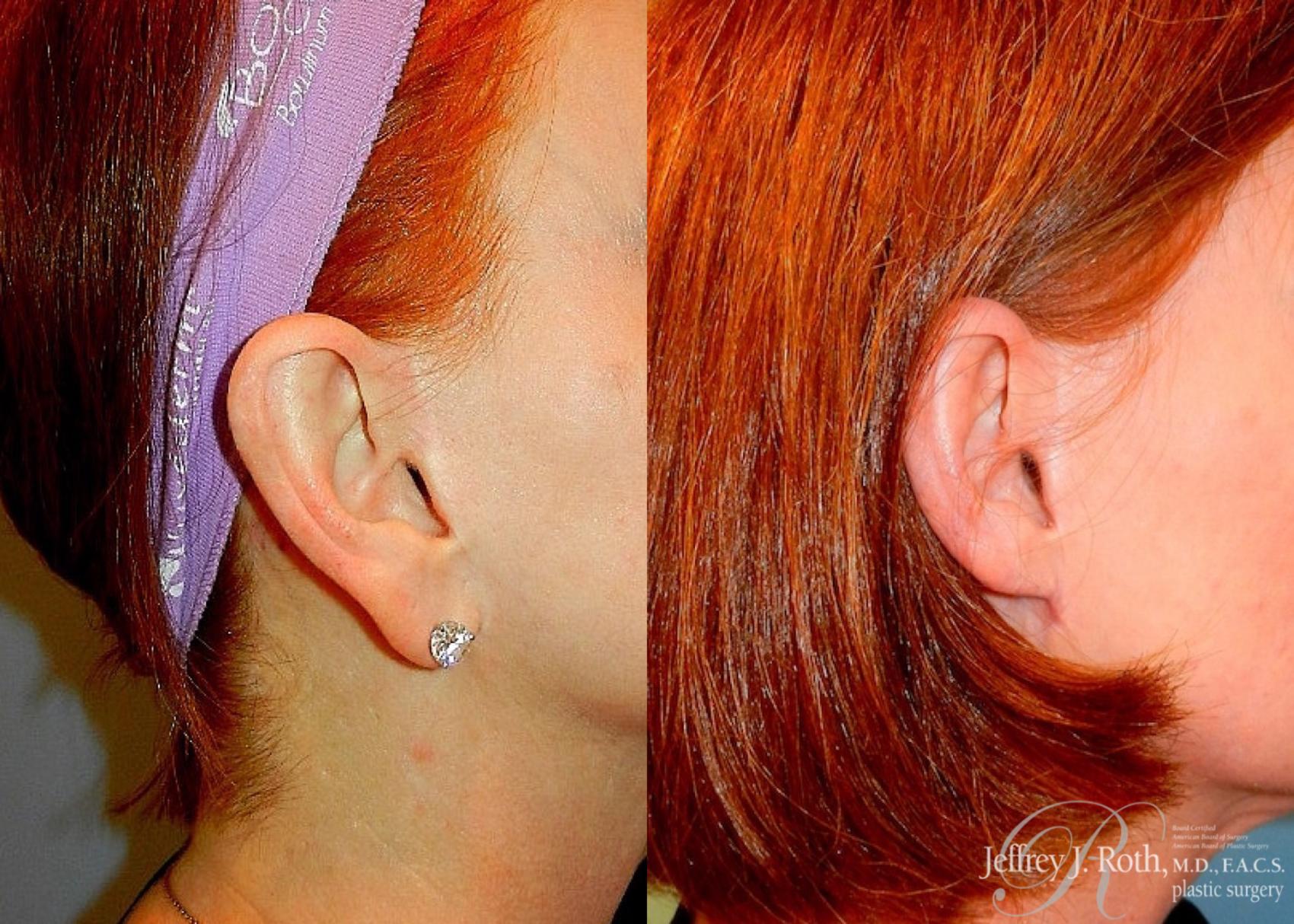 Before & After Earlobe Reduction Surgery Case 119 View #2 View in Las Vegas, NV