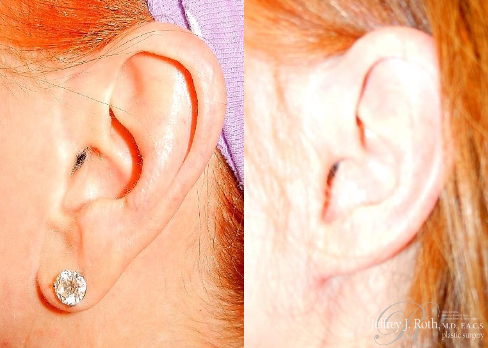 Before & After Earlobe Reduction Surgery Case 119 View #3 View in Las Vegas, NV