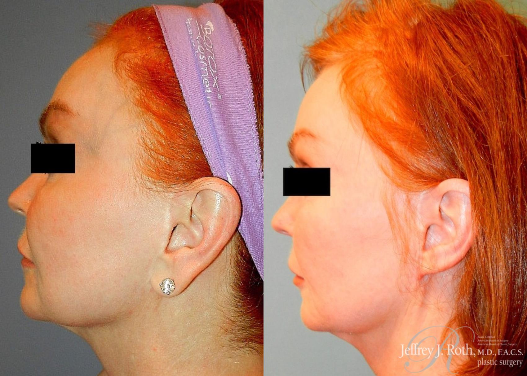 Before & After Earlobe Reduction Surgery Case 119 View #4 View in Las Vegas, NV