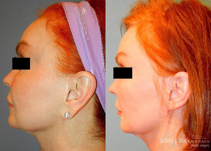 Before & After Earlobe Reduction Surgery Case 119 View #4 View in Las Vegas and Henderson, NV