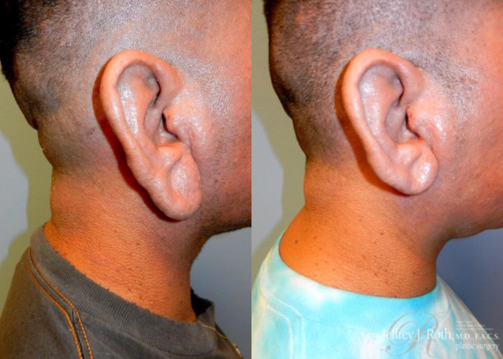 Before & After Earlobe Reduction Surgery Case 120 View #1 View in Las Vegas, NV
