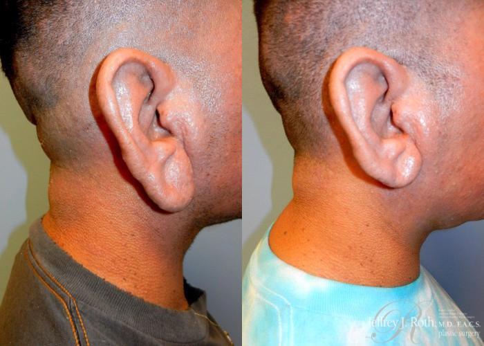 Before & After Earlobe Reduction Surgery Case 120 View #1 View in Las Vegas and Henderson, NV