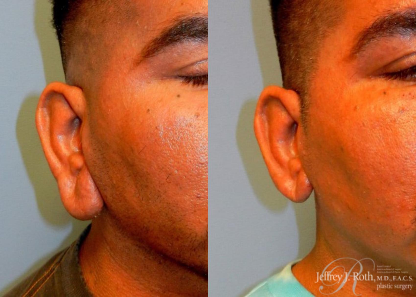 Before & After Earlobe Reduction Surgery Case 120 View #2 View in Las Vegas, NV