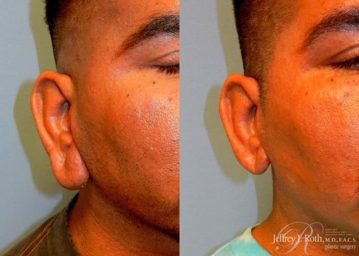Before & After Earlobe Reduction Surgery Case 120 View #2 View in Las Vegas and Henderson, NV