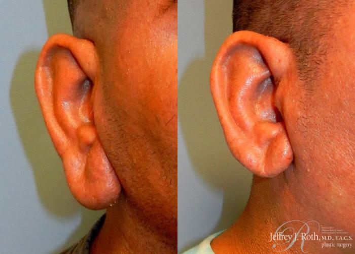 Before & After Earlobe Reduction Surgery Case 120 View #3 View in Las Vegas, NV