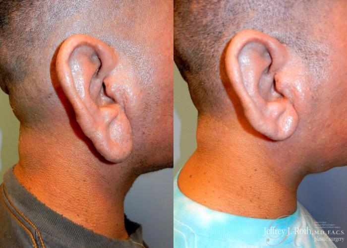 Before & After Earlobe Reduction Surgery Case 120 View #4 View in Las Vegas and Henderson, NV