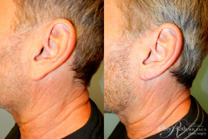 Before & After Earlobe Reduction Surgery Case 229 Left Side View in Las Vegas, NV