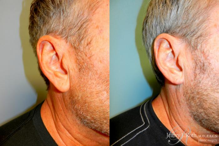 Before & After Earlobe Reduction Surgery Case 229 Right Oblique View in Las Vegas, NV