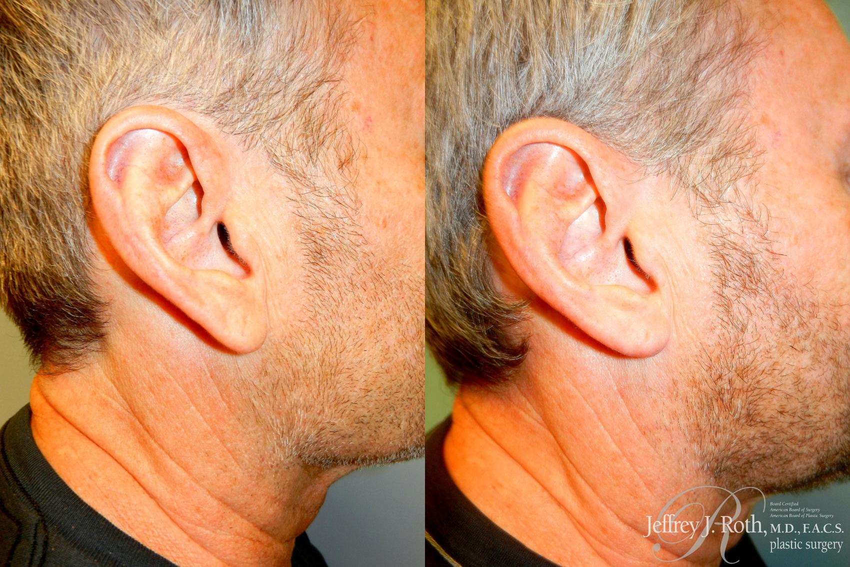 Before & After Earlobe Reduction Surgery Case 229 Right Side View in Las Vegas, NV