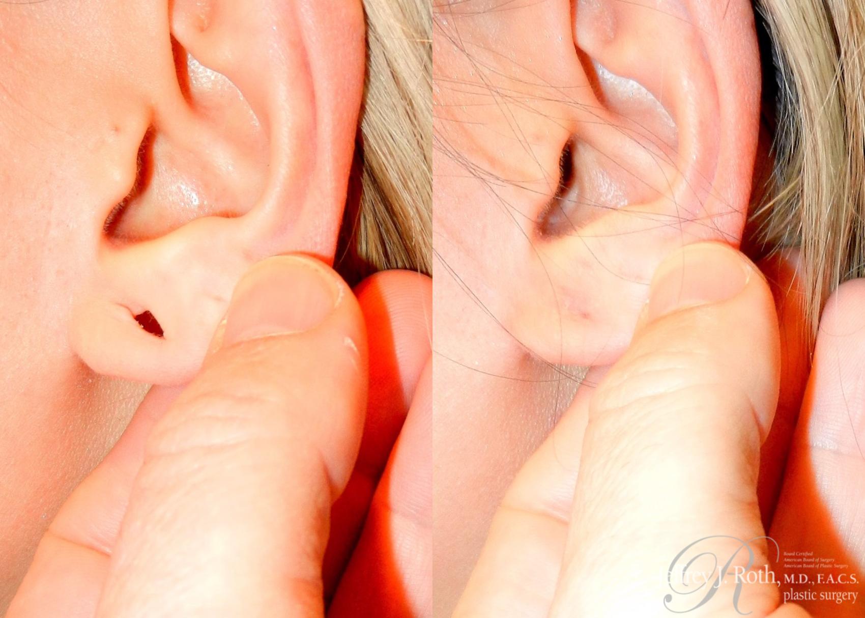 Before & After Earlobe Repair Surgery Case 121 View #2 View in Las Vegas, NV